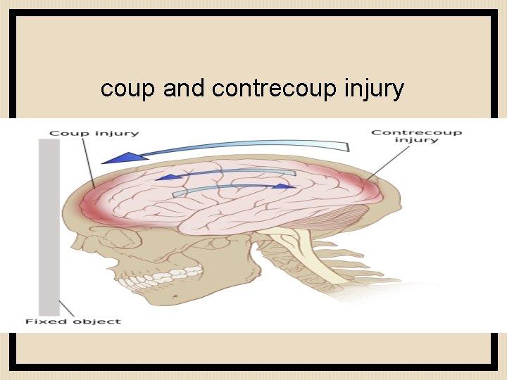 coup and contrecoup injury 