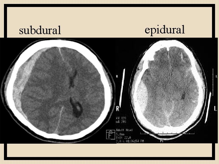 subdural epidural 