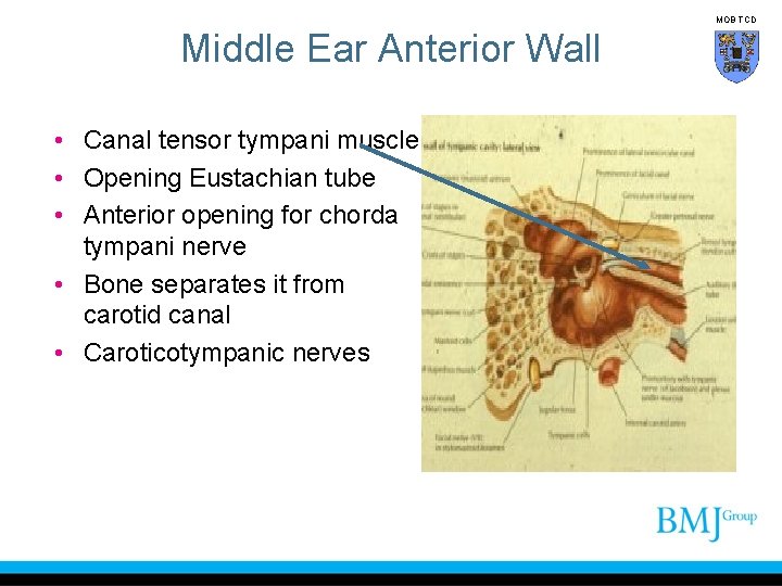 MOB TCD Middle Ear Anterior Wall • Canal tensor tympani muscle • Opening Eustachian