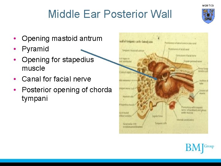 MOB TCD Middle Ear Posterior Wall • Opening mastoid antrum • Pyramid • Opening