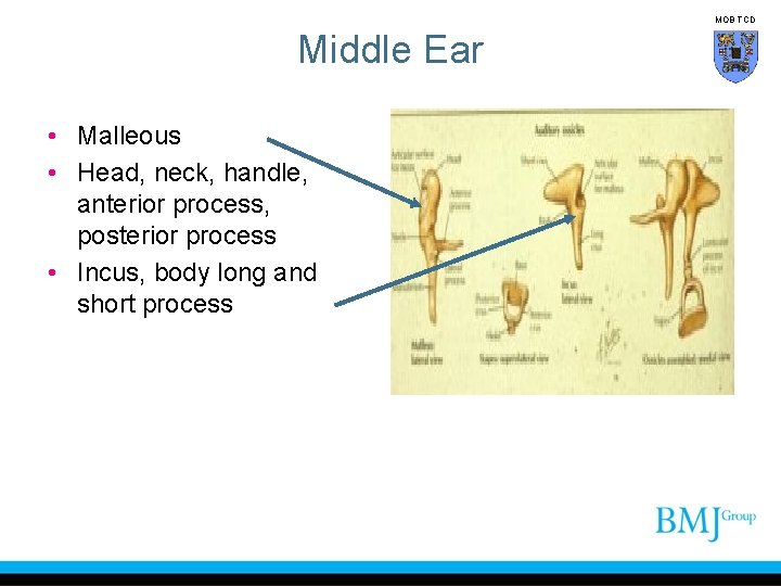 MOB TCD Middle Ear • Malleous • Head, neck, handle, anterior process, posterior process