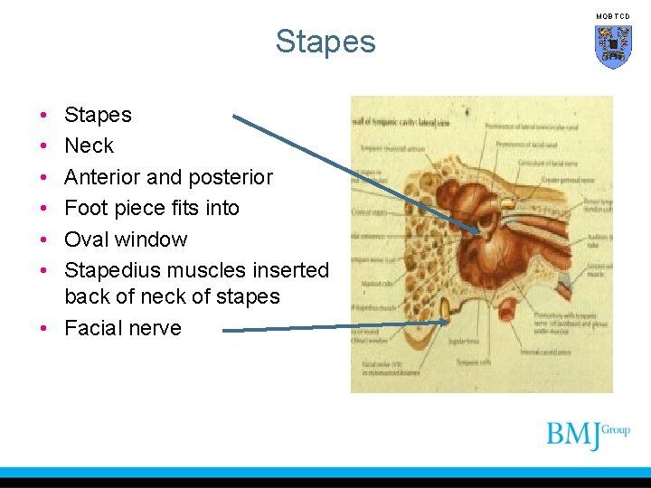 MOB TCD Stapes • • • Stapes Neck Anterior and posterior Foot piece fits