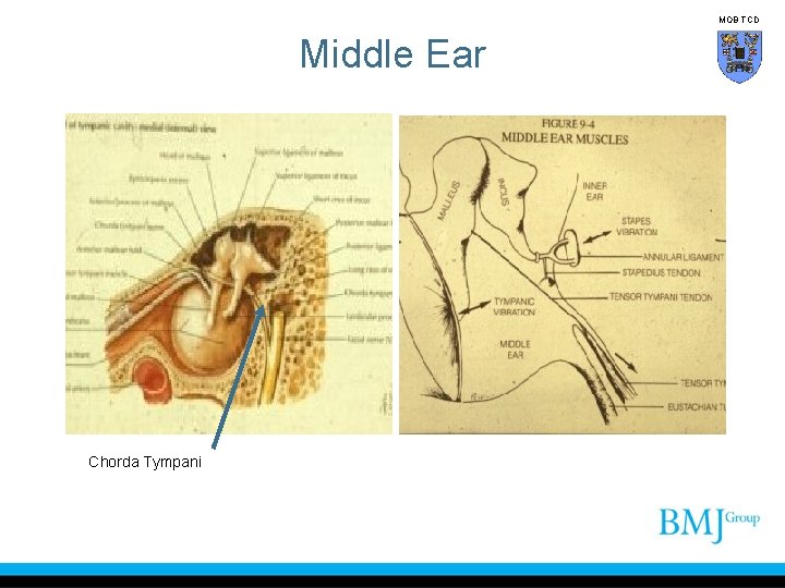 MOB TCD Middle Ear Chorda Tympani 