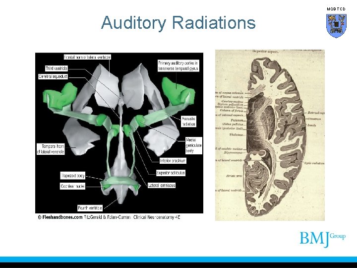 MOB TCD Auditory Radiations 