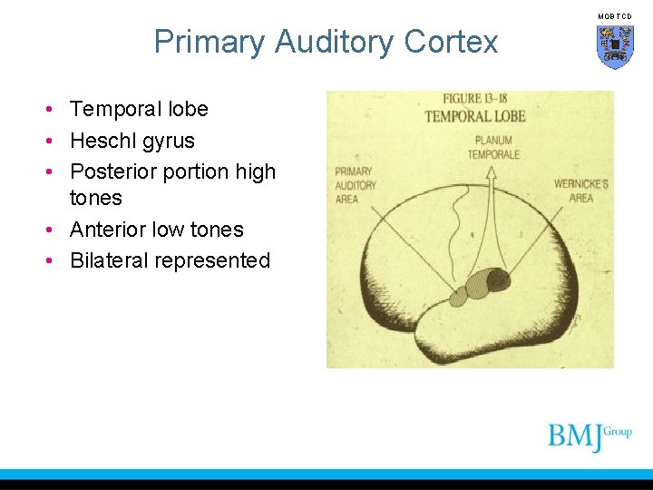 MOB TCD Primary Auditory Cortex • Temporal lobe • Heschl gyrus • Posterior portion