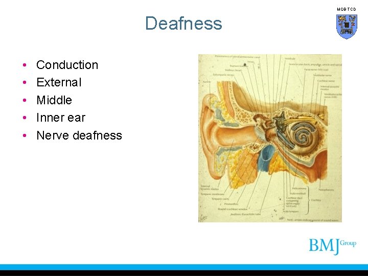 MOB TCD Deafness • • • Conduction External Middle Inner ear Nerve deafness 