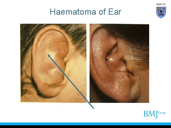 MOB TCD Haematoma of Ear 