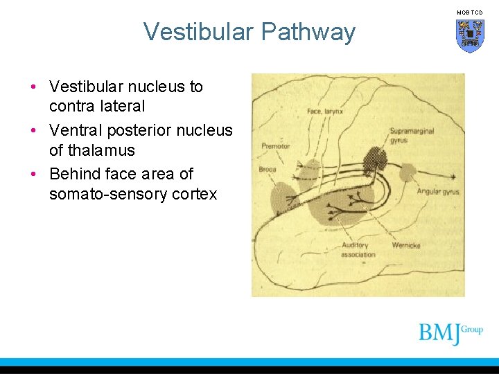 MOB TCD Vestibular Pathway • Vestibular nucleus to contra lateral • Ventral posterior nucleus