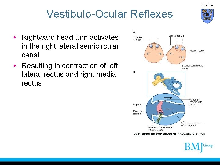 MOB TCD Vestibulo-Ocular Reflexes • Rightward head turn activates in the right lateral semicircular