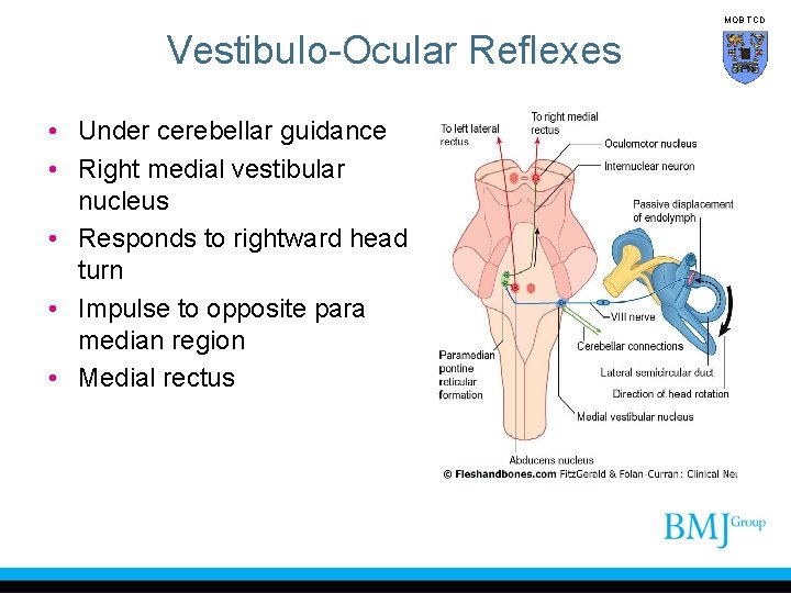 MOB TCD Vestibulo-Ocular Reflexes • Under cerebellar guidance • Right medial vestibular nucleus •