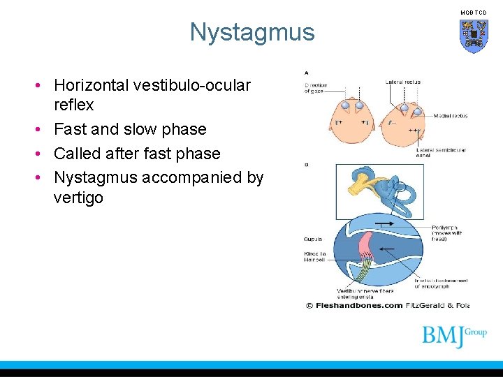 MOB TCD Nystagmus • Horizontal vestibulo-ocular reflex • Fast and slow phase • Called