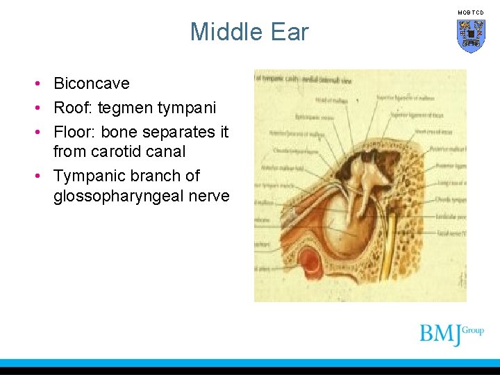 MOB TCD Middle Ear • Biconcave • Roof: tegmen tympani • Floor: bone separates