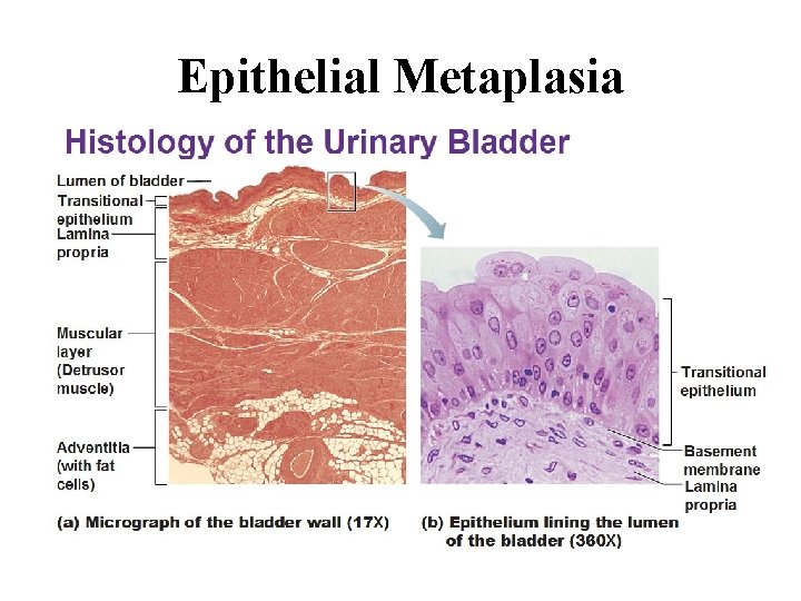 Epithelial Metaplasia 