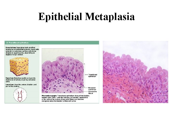 Epithelial Metaplasia 