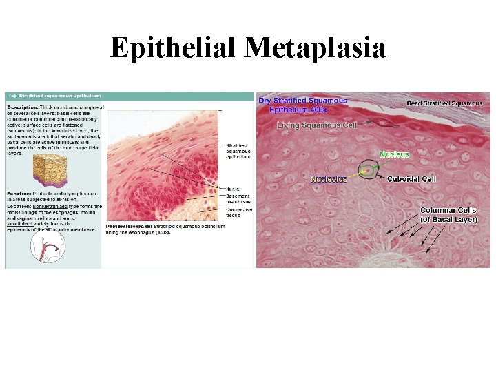 Epithelial Metaplasia 