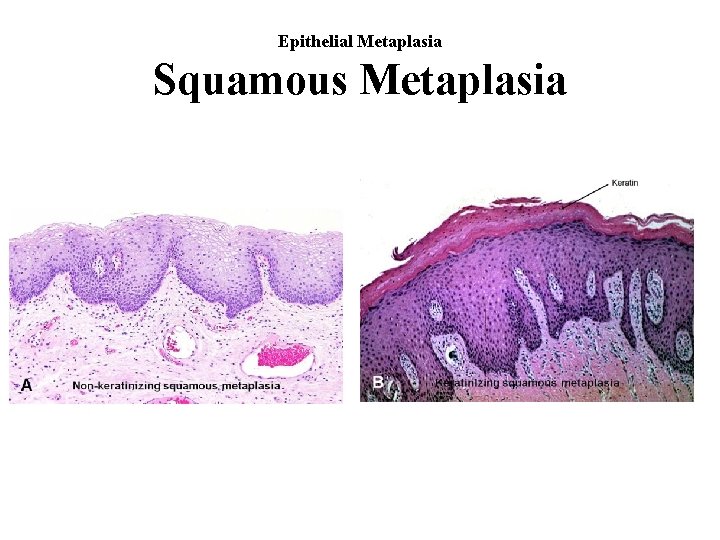 Epithelial Metaplasia Squamous Metaplasia 