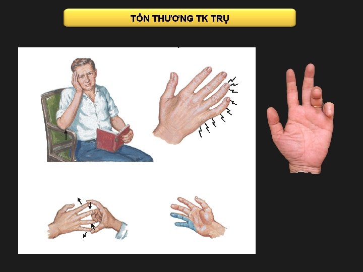 TỔN THƯƠNG TK TRỤ 