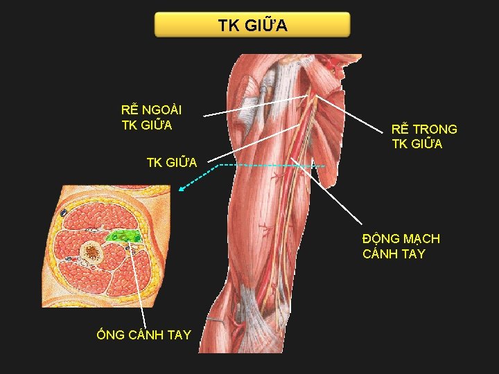 TK GIỮA RỄ NGOÀI TK GIỮA RỄ TRONG TK GIỮA ĐỘNG MẠCH CÁNH TAY