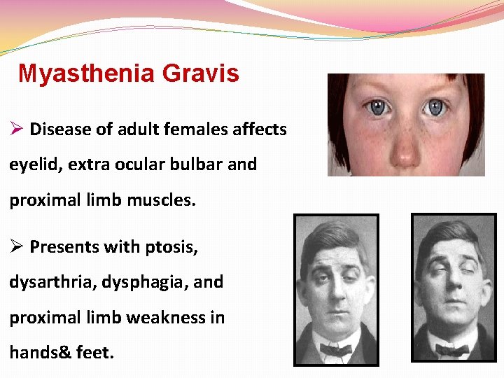 Myasthenia Gravis Ø Disease of adult females affects eyelid, extra ocular bulbar and proximal