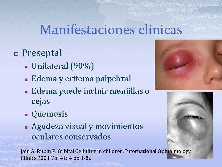 Manifestaciones clínicas p Preseptal n n n Unilateral (90%) Edema y eritema palpebral Edema