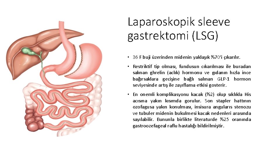 Laparoskopik sleeve gastrektomi (LSG) • 36 F buji üzerinden midenin yaklaşık %70’i çıkarılır. •