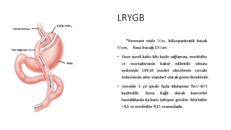 LRYGB *Remnant mide 30 cc, biliyopankratik bacak 50 cm, Roux bacağı 150 cm •