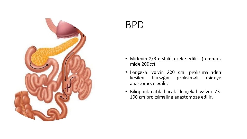 BPD • Midenin 2/3 distali rezeke edilir (remnant mide 200 cc) • İleoçekal valvin