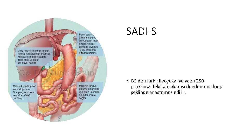 SADI-S • DS’den farkı; ileoçekal valvden 250 proksimaldeki barsak ansı duedonuma loop şeklinde anastomoz