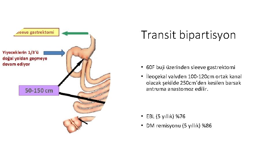 Transit bipartisyon • 60 F buji üzerinden sleeve gastrektomi • İleoçekal valvden 100 -120