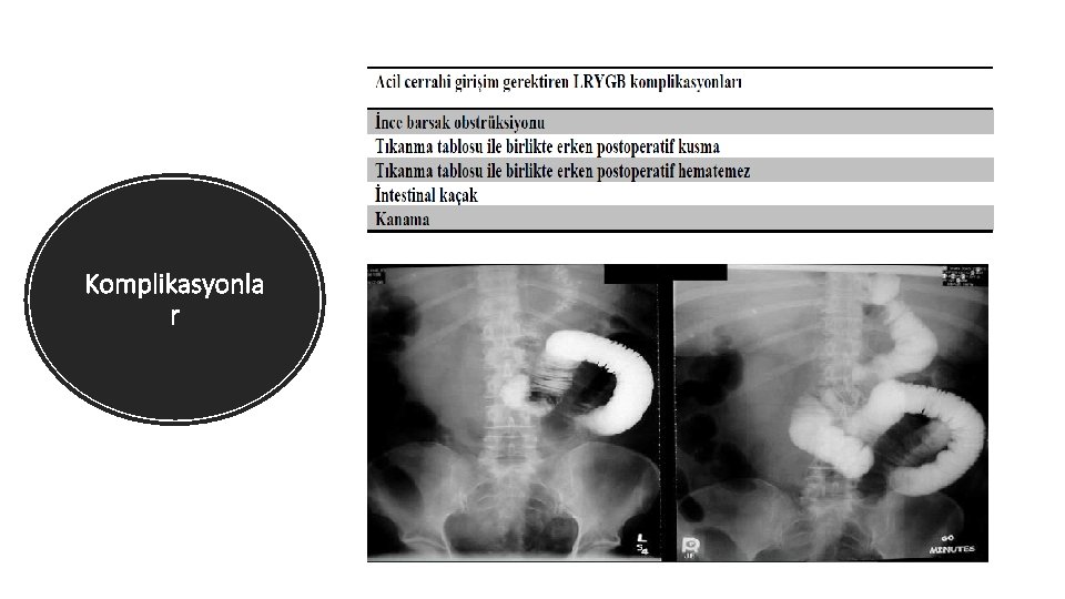 Komplikasyonla r 