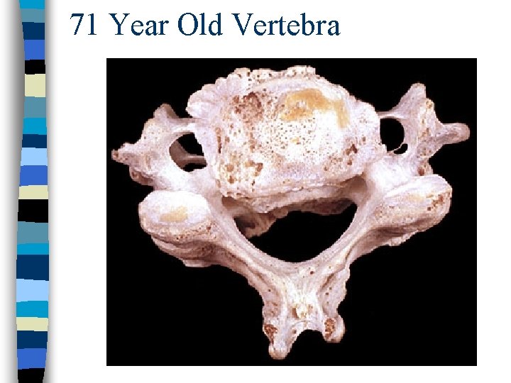 71 Year Old Vertebra 