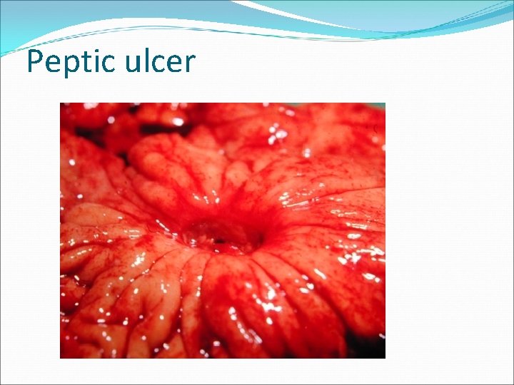 Peptic ulcer 