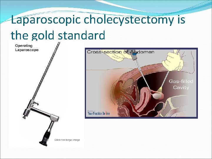 Laparoscopic cholecystectomy is the gold standard 