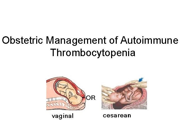 Obstetric Management of Autoimmune Thrombocytopenia 