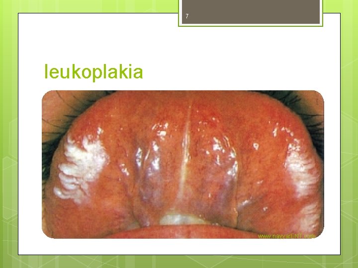 7 leukoplakia www. nayyar. ENT. com 