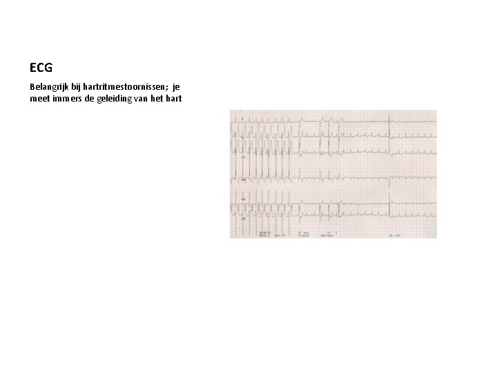 ECG Belangrijk bij hartritmestoornissen; je meet immers de geleiding van het hart 