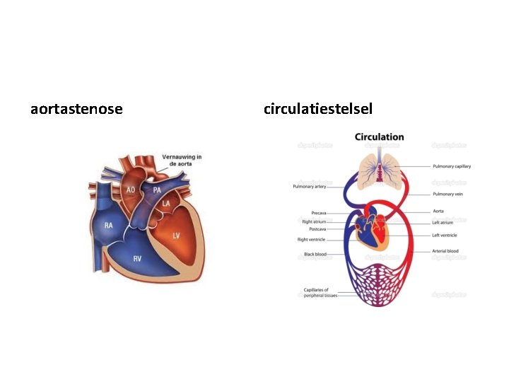 aortastenose circulatiestelsel 