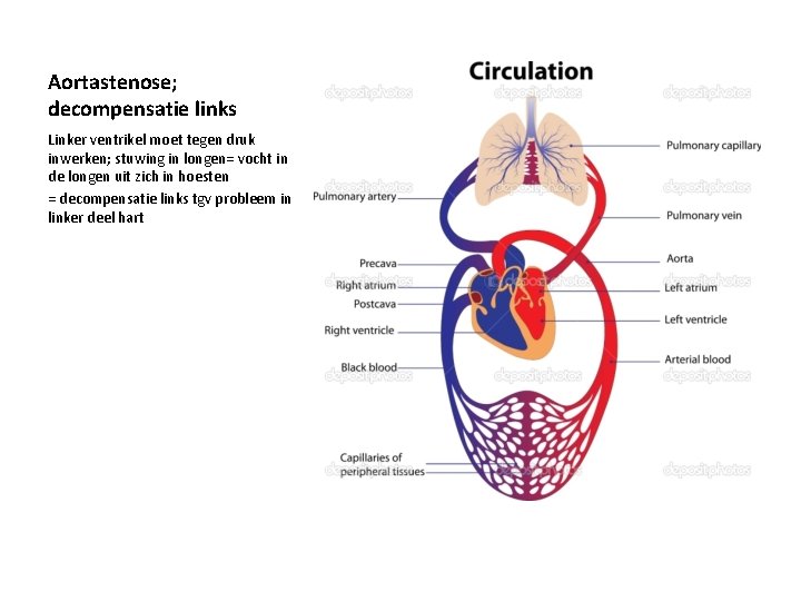 Aortastenose; decompensatie links Linker ventrikel moet tegen druk inwerken; stuwing in longen= vocht in