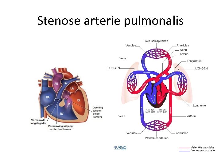 Stenose arterie pulmonalis 