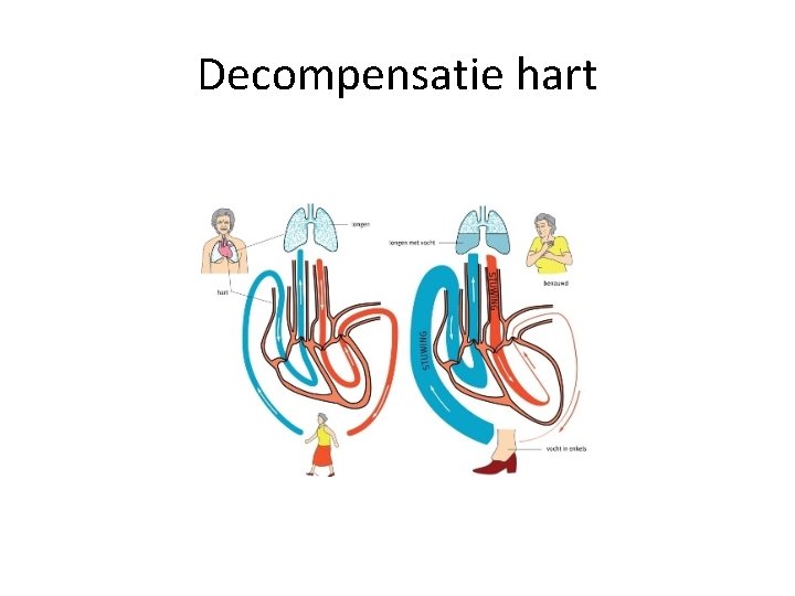 Decompensatie hart 