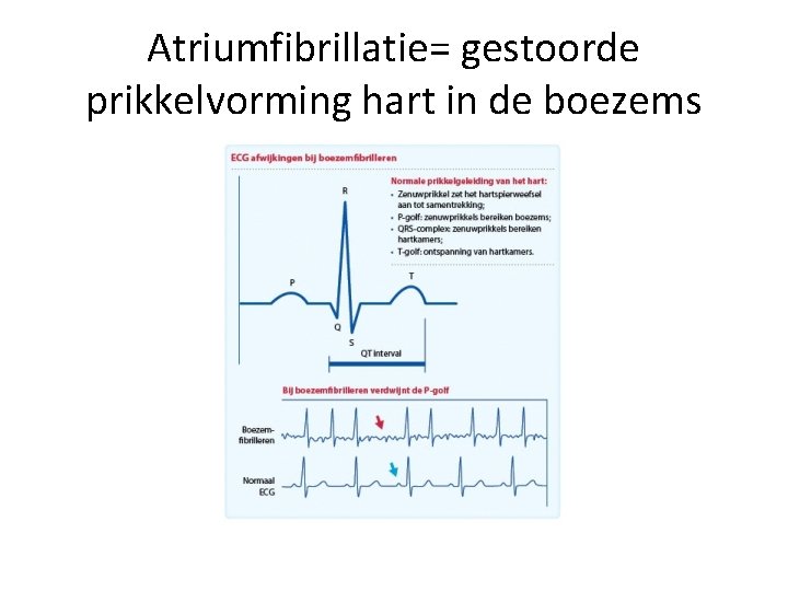 Atriumfibrillatie= gestoorde prikkelvorming hart in de boezems 