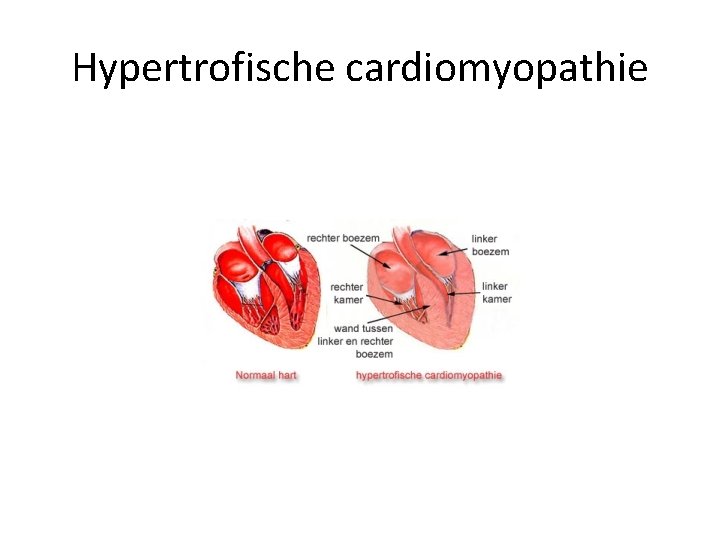 Hypertrofische cardiomyopathie 