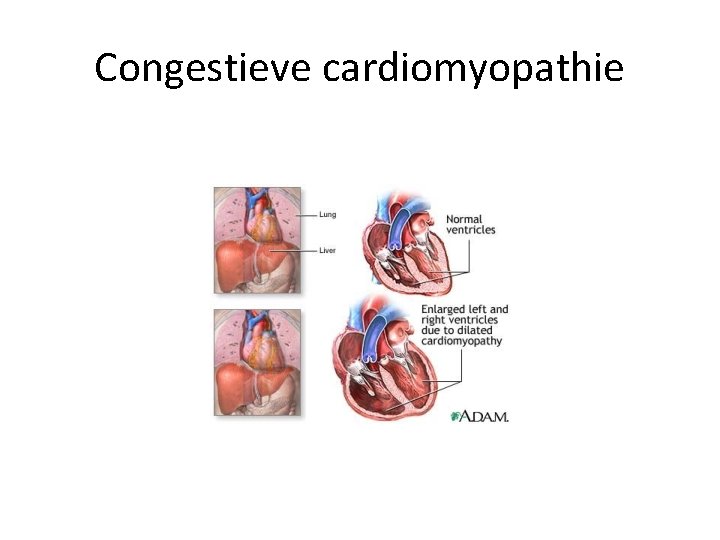 Congestieve cardiomyopathie 