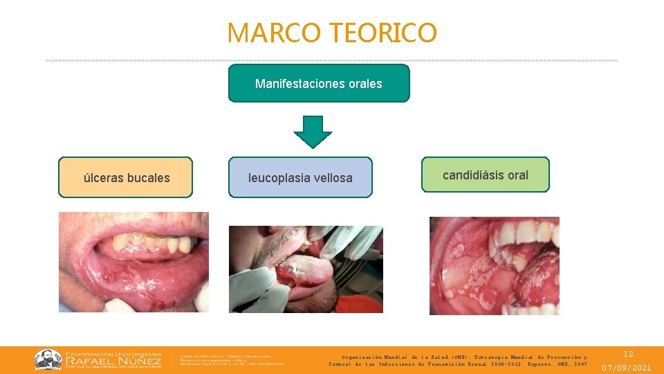 MARCO TEORICO Manifestaciones orales úlceras bucales leucoplasia vellosa candidiásis oral Organización Mundial de la