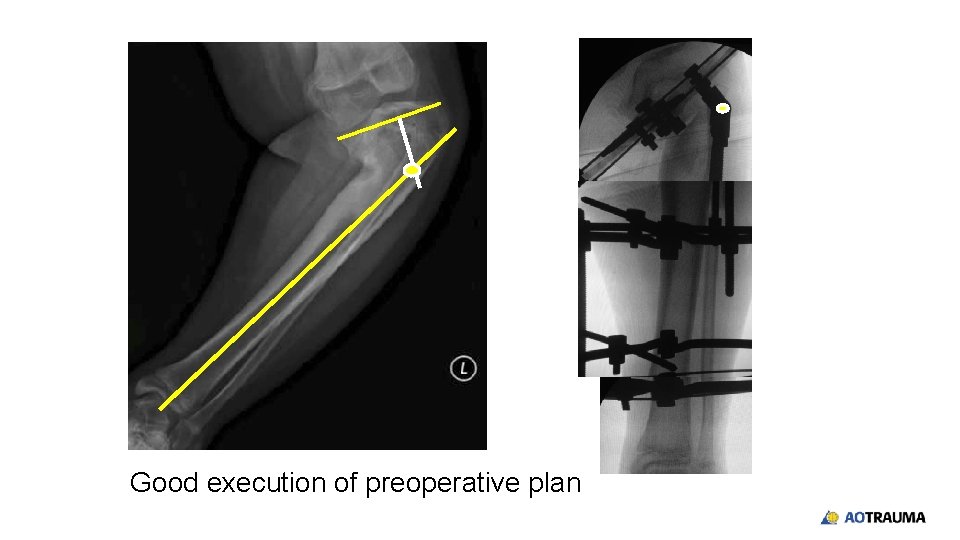 Good execution of preoperative plan 