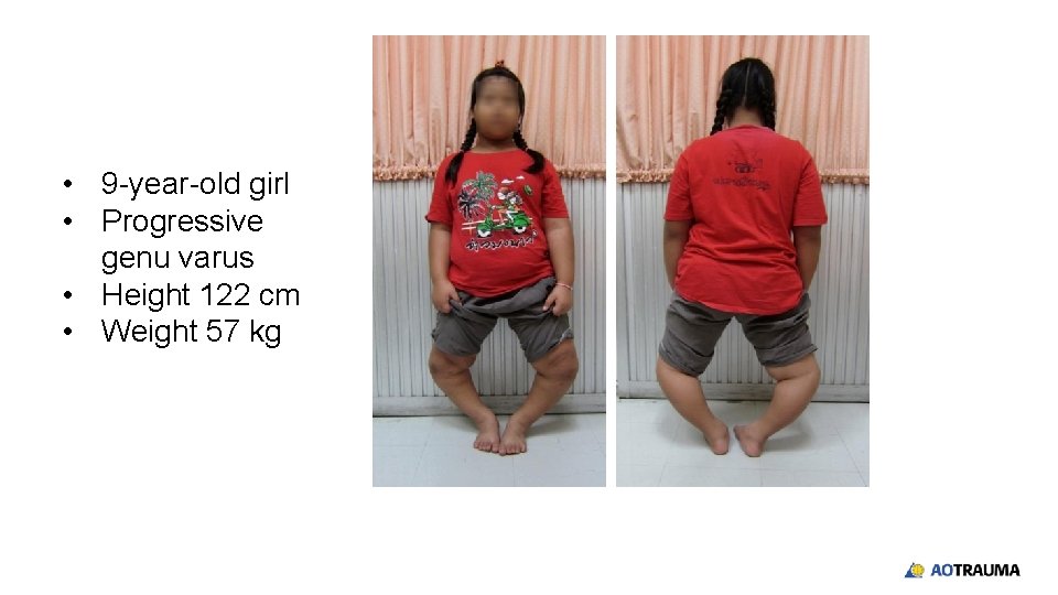  • 9 -year-old girl • Progressive genu varus • Height 122 cm •