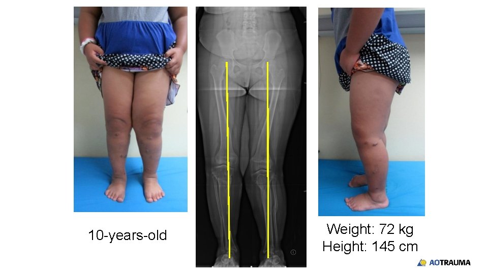 10 -years-old Weight: 72 kg Height: 145 cm 