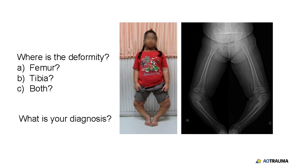 Where is the deformity? a) Femur? b) Tibia? c) Both? What is your diagnosis?