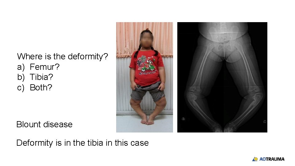 Where is the deformity? a) Femur? b) Tibia? c) Both? Blount disease Deformity is