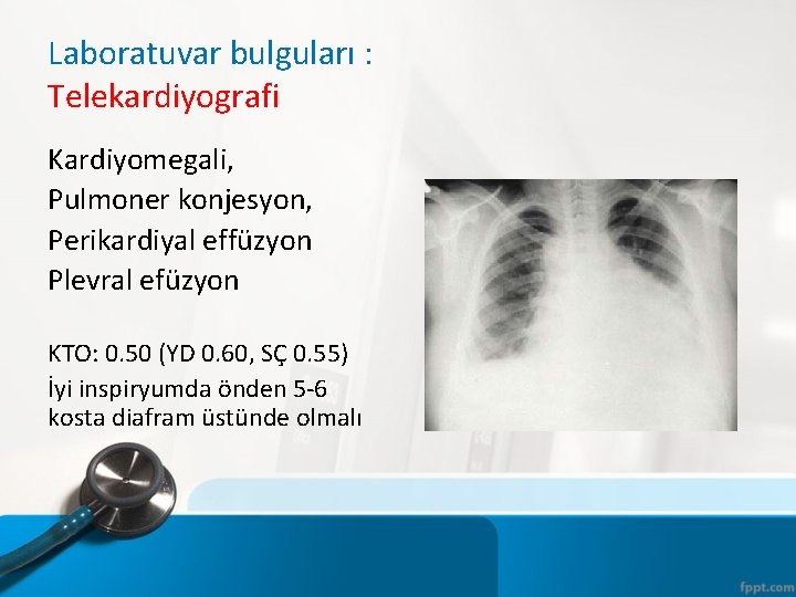 Laboratuvar bulguları : Telekardiyografi Kardiyomegali, Pulmoner konjesyon, Perikardiyal effüzyon Plevral efüzyon KTO: 0. 50